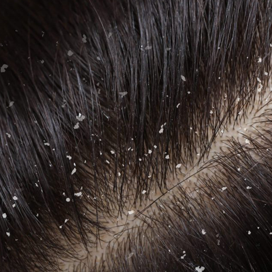 Dermatite Seborreica Champô Sólido