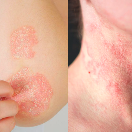 Eczema contagioso