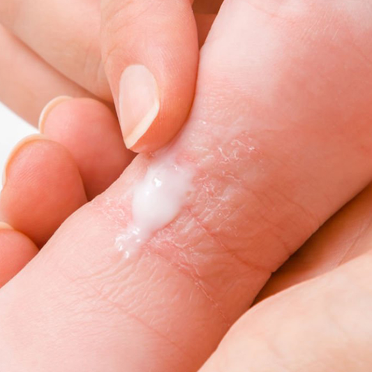 Eczema Sabonetes Artesanais